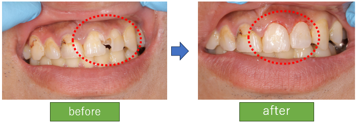 前歯を短期間できれいにしたい(ダイレクトボンディング)