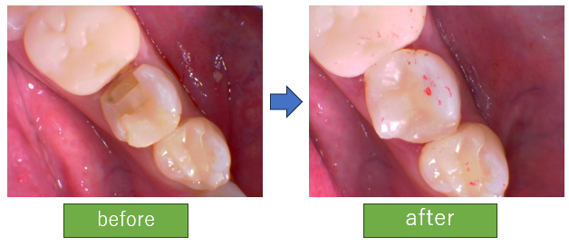 セラミック割れるなんとかしたい(ダイレクトボンディング)