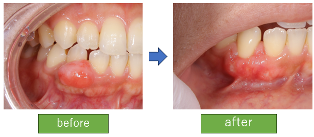 歯茎の出来物をとりたい(エプーリス)