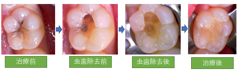 短期間で虫歯の治療をしたい(ダイレクトボンディング)