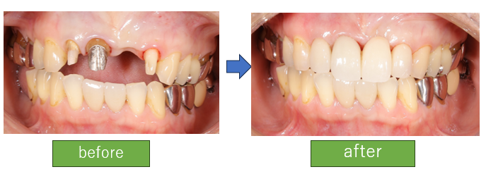 白くて明るい歯をいれたい(ジルコニアセラミックブリッジ)
