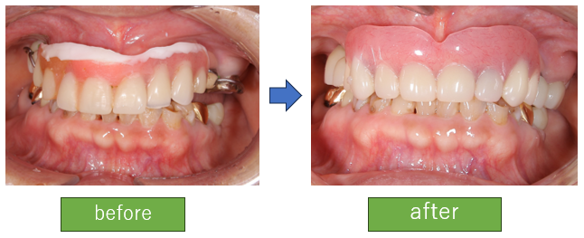 老後も管理がしやすく動かない義歯が欲しい(インプラントオーバーデンチャー)