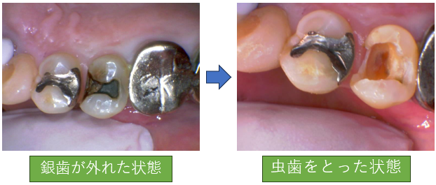 銀歯の下に大きな虫歯！