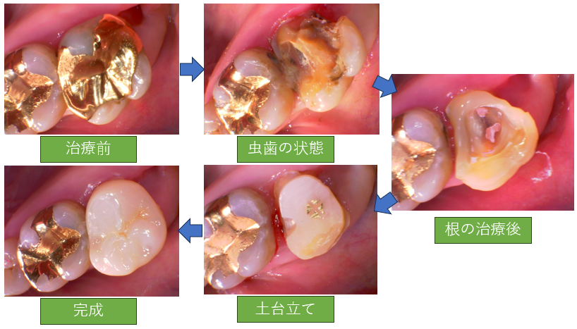 虫歯治療の簡単な流れ