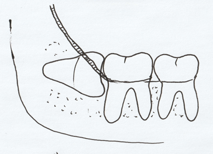 親知らずは抜いたほうがいいの？(抜歯したほうがよいタイプ紹介)